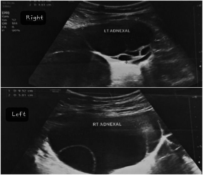 Challenge faced in diagnosis and treatment of congenital hypothyroidism presenting with isosexual puberty and bilateral ovarian mass in low and middle income country: a case report.