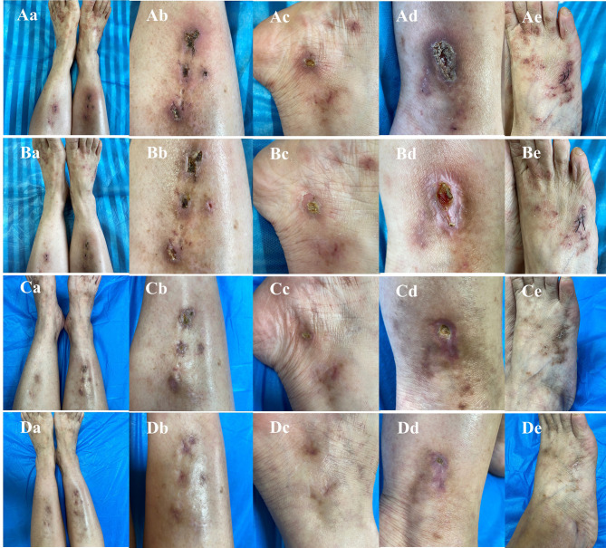 Successful Treatment of Refractory Livedoid Vasculopathy with Upadacitinib: A Case Report.