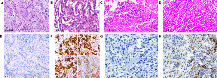 Pathologic complete response of advanced hepatoid adenocarcinoma of the stomach following immuno-chemotherapy and conversion surgery: a rare case report and review of the literature.