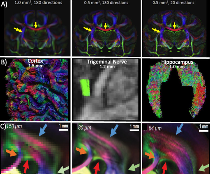 Rethinking tractography and neuroanatomy: does image resolution hold the key?
