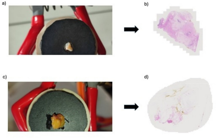 Diffuse reflectance and fluorescence spectroscopy for breast conserving surgery.