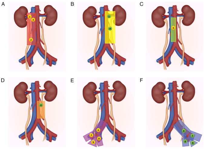Lymphadenectomy in upper tract urothelial carcinoma: Clinical insights and controversies (Review).
