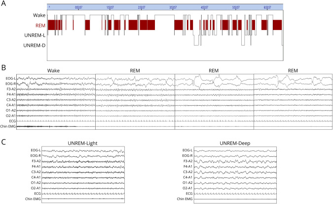 Unique Polysomnography Pattern Leading to the Diagnosis of Anti-Ma2 Encephalitis.