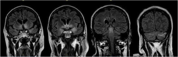 Unique Polysomnography Pattern Leading to the Diagnosis of Anti-Ma2 Encephalitis.