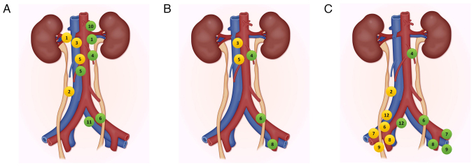 Lymphadenectomy in upper tract urothelial carcinoma: Clinical insights and controversies (Review).