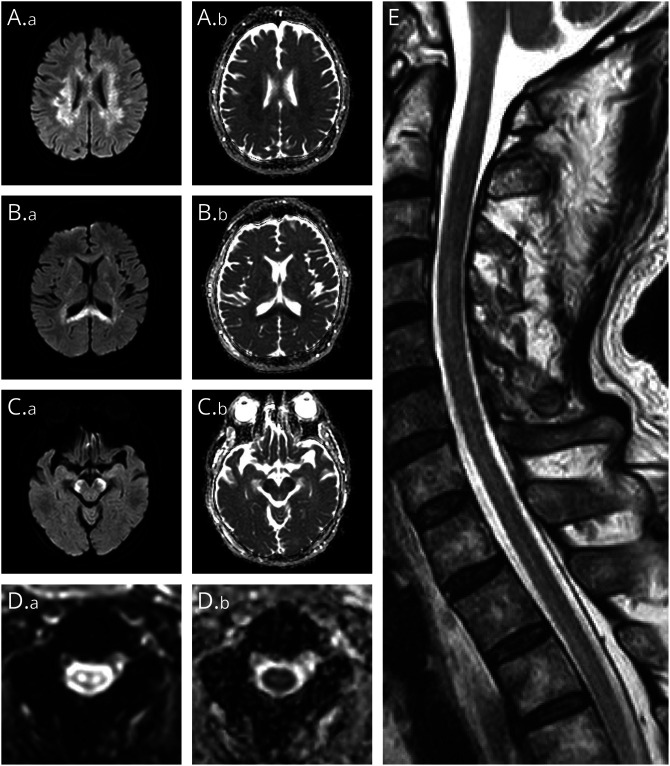 Extensive Corticospinal Tract Involvement in a Patient With Autoimmune Glial Fibrillary Acidic Protein Astrocytopathy.