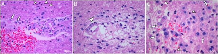 Complement Factor I Deficiency With Acute Hemorrhagic Leukoencephalitis and Longitudinally Extensive Transverse Myelitis: A Case Report.
