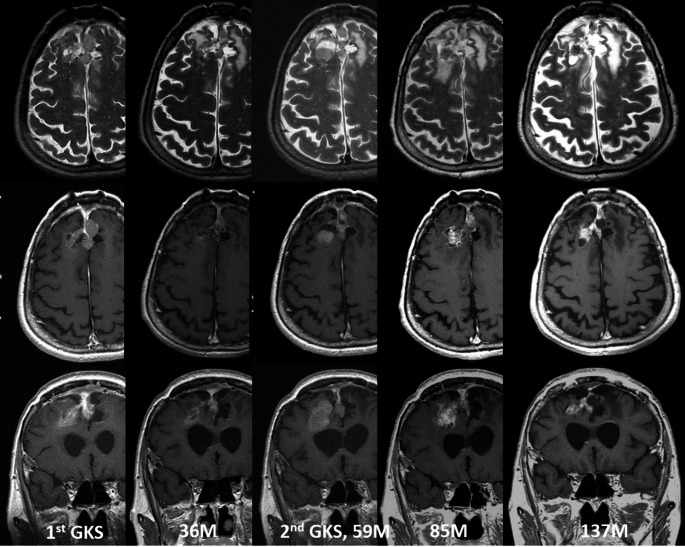 Repeated stereotactic radiosurgery for high grade meningioma.