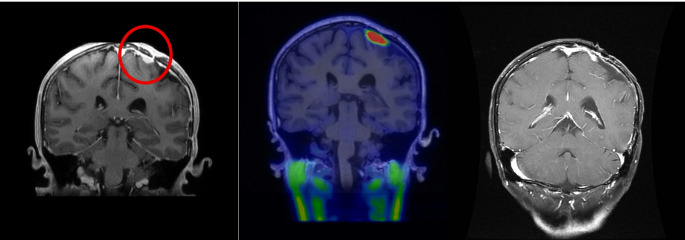 Recurrent meningioma treated with boron neutron capture therapy: a feasibility study with dosimetric and clinical correlates.