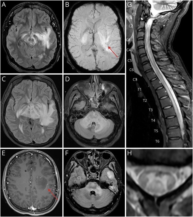 Complement Factor I Deficiency With Acute Hemorrhagic Leukoencephalitis and Longitudinally Extensive Transverse Myelitis: A Case Report.