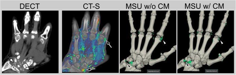 Current and future role of CT and advanced CT applications in inflammatory arthritis in the clinic and trials.