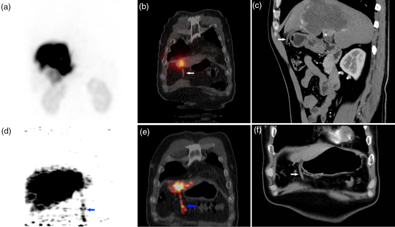Discordant patterns of anterior abdominal wall radiotracer accumulation in yttrium-90 selective internal radiation therapy: implications for pretherapeutic planning and posttreatment monitoring.