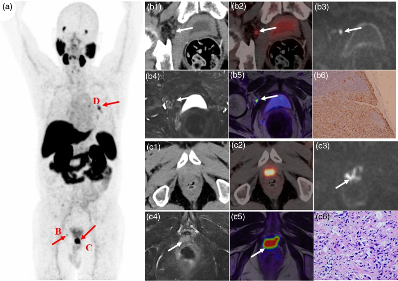 Diagnostic value of 18 F-prostate-specific membrane antigen-1007 PET/MRI versus 18 F-prostate-specific membrane antigen-1007 PET/computed tomography for biochemical recurrence of prostate cancer after radical prostatectomy.