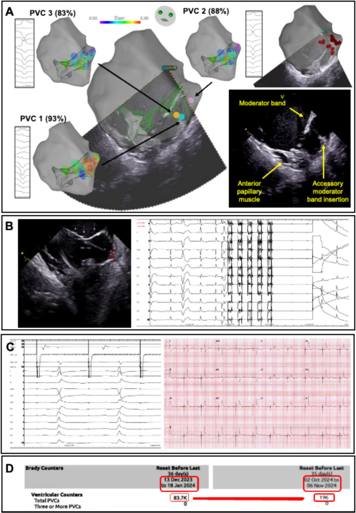 Pulsed field ablation of ventricular arrhythmias arising from intracavitary structures: insights from a clinical case series.