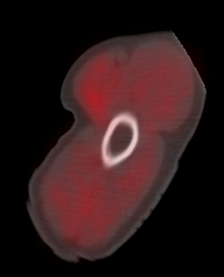 Application of [ 18 F]-fluorodeoxyglucose PET/computed tomography to measure volume and metabolic activity of arm muscles.