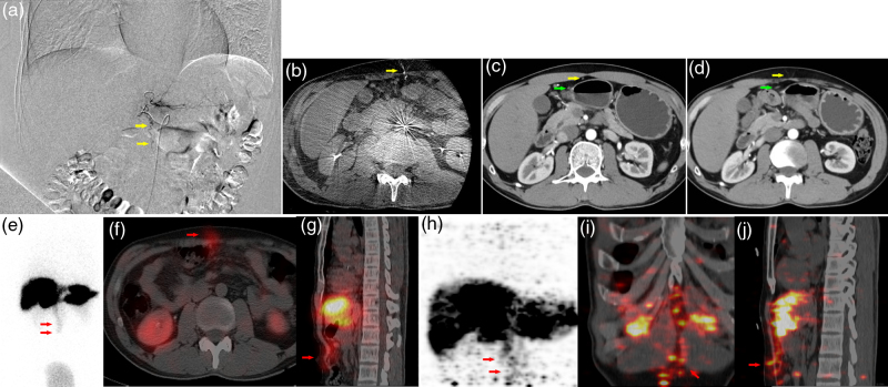 Discordant patterns of anterior abdominal wall radiotracer accumulation in yttrium-90 selective internal radiation therapy: implications for pretherapeutic planning and posttreatment monitoring.