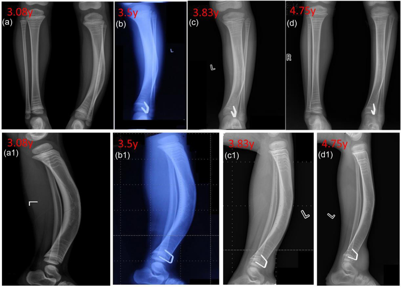 Clinical study of the 'U'-shaped staple-guided growth technique in the treatment of congenital anterolateral bowing of the tibia in children.