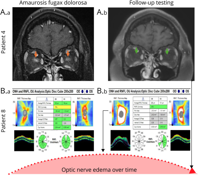 Amaurosis Fugax Dolorosa: A Prodromal Syndrome in Optic Neuritis Associated With Myelin Oligodendrocyte Glycoprotein Antibody-Associated Disease.