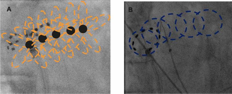 Acute outcomes of cryoballoon vs. circular vs. pentaspline pulsed-field ablation catheters in combined pulmonary vein isolation and roof line ablation.