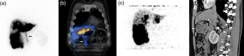 Discordant patterns of anterior abdominal wall radiotracer accumulation in yttrium-90 selective internal radiation therapy: implications for pretherapeutic planning and posttreatment monitoring.