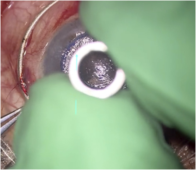 Surgical Considerations for the Human Implantation of the Gore Synthetic Corneal Device.