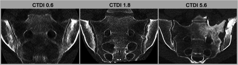 Current and future role of CT and advanced CT applications in inflammatory arthritis in the clinic and trials.