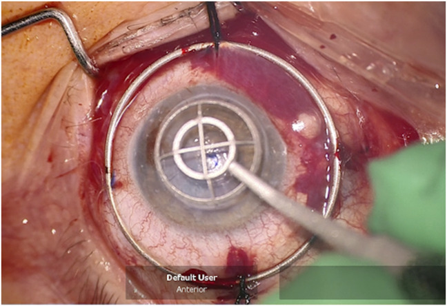 Surgical Considerations for the Human Implantation of the Gore Synthetic Corneal Device.