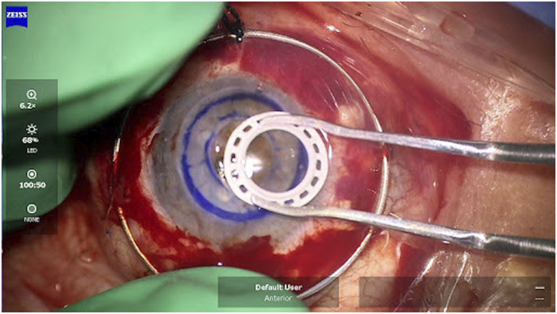 Surgical Considerations for the Human Implantation of the Gore Synthetic Corneal Device.