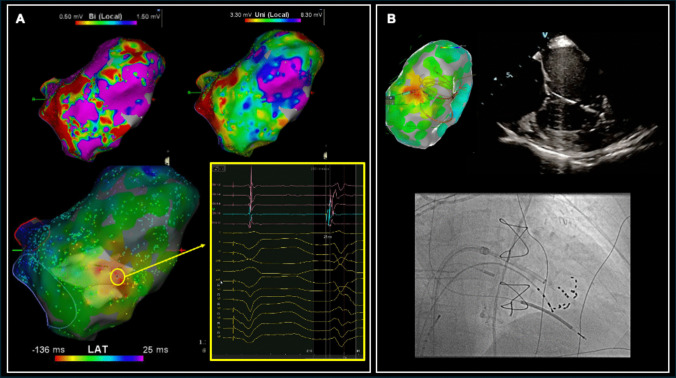 Pulsed field ablation of ventricular arrhythmias arising from intracavitary structures: insights from a clinical case series.