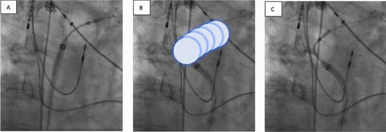 Acute outcomes of cryoballoon vs. circular vs. pentaspline pulsed-field ablation catheters in combined pulmonary vein isolation and roof line ablation.