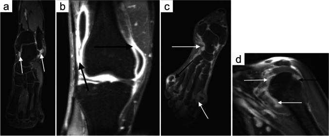 Whole-body MRI in arthritis.
