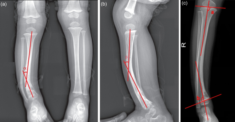 Clinical study of the 'U'-shaped staple-guided growth technique in the treatment of congenital anterolateral bowing of the tibia in children.