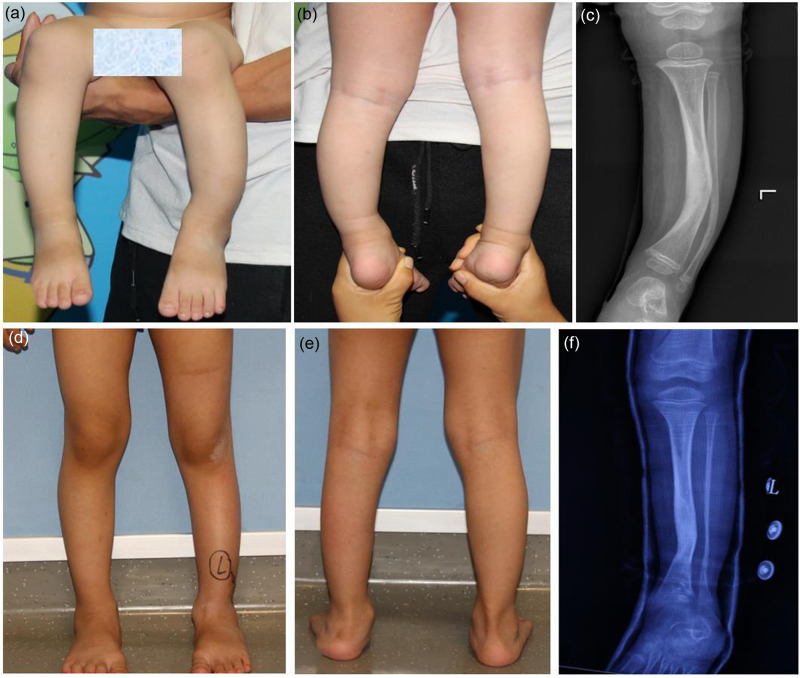 Clinical study of the 'U'-shaped staple-guided growth technique in the treatment of congenital anterolateral bowing of the tibia in children.