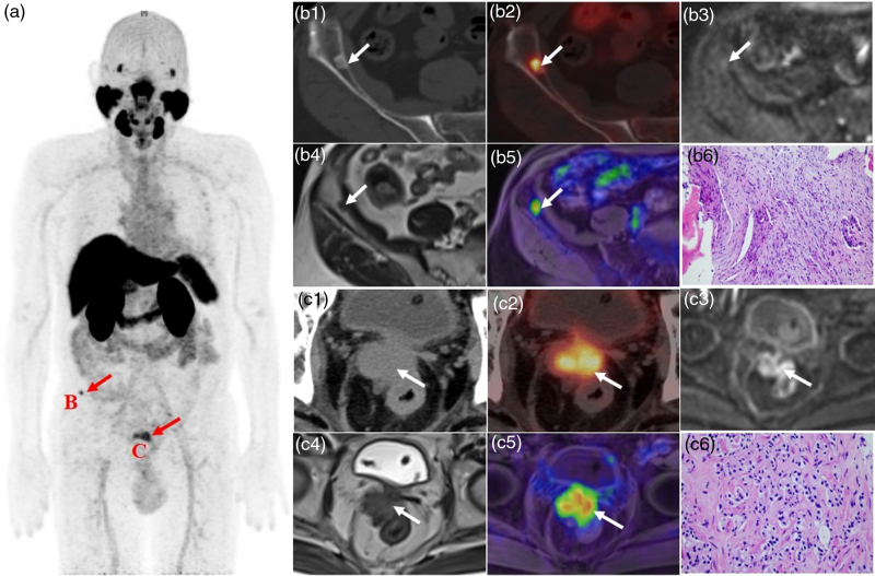 Diagnostic value of 18 F-prostate-specific membrane antigen-1007 PET/MRI versus 18 F-prostate-specific membrane antigen-1007 PET/computed tomography for biochemical recurrence of prostate cancer after radical prostatectomy.