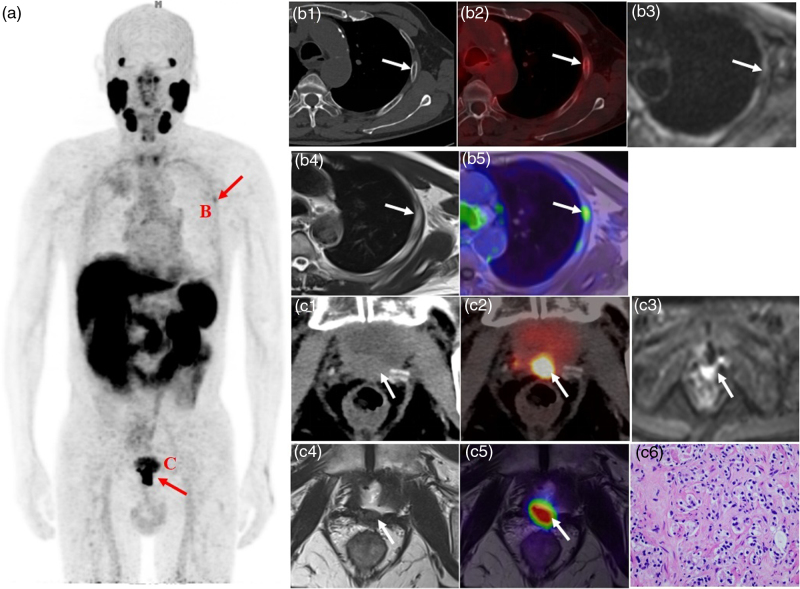 Diagnostic value of 18 F-prostate-specific membrane antigen-1007 PET/MRI versus 18 F-prostate-specific membrane antigen-1007 PET/computed tomography for biochemical recurrence of prostate cancer after radical prostatectomy.