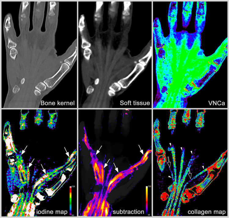 Current and future role of CT and advanced CT applications in inflammatory arthritis in the clinic and trials.