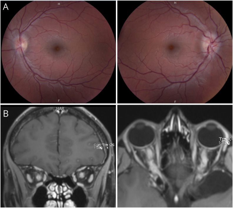 Amaurosis Fugax Dolorosa: A Prodromal Syndrome in Optic Neuritis Associated With Myelin Oligodendrocyte Glycoprotein Antibody-Associated Disease.