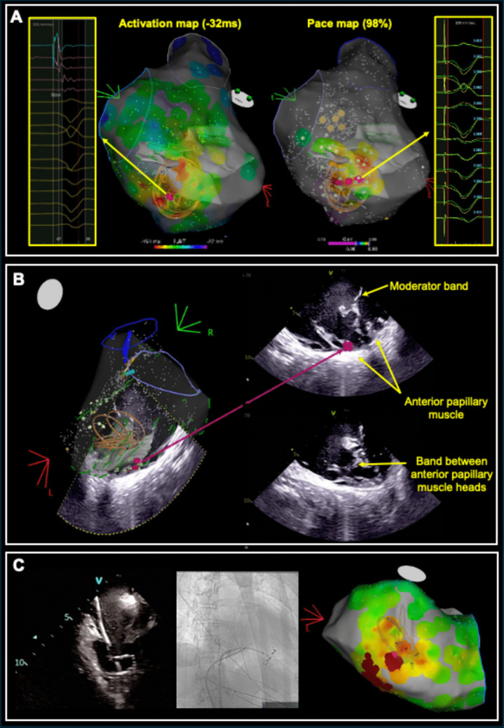 Pulsed field ablation of ventricular arrhythmias arising from intracavitary structures: insights from a clinical case series.