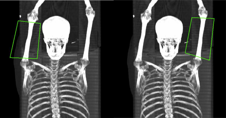 Application of [ 18 F]-fluorodeoxyglucose PET/computed tomography to measure volume and metabolic activity of arm muscles.