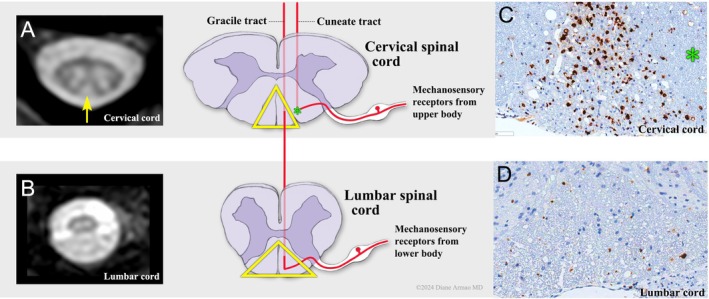 T2 Hyperintensities in Gracile Tracts of Cervical Spinal Cord in Giant Axonal Neuropathy (GAN).