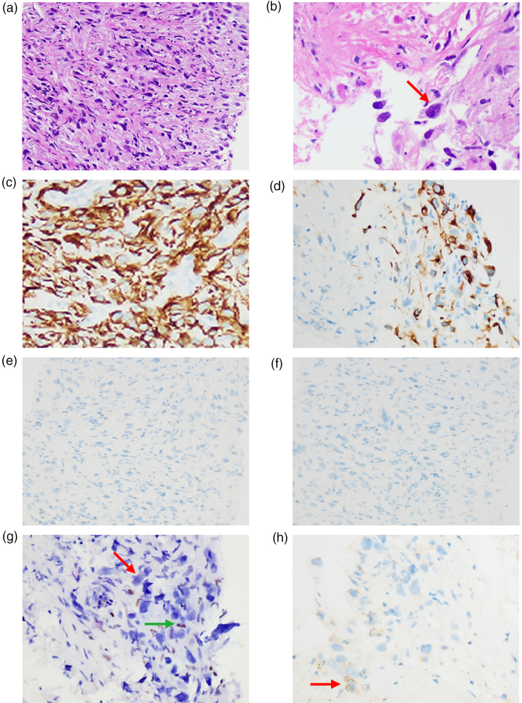 Pembrolizumab treatment in SMARCA4-deficient nonsmall cell lung cancer: high tumor mutational burden and programmed death-ligand 1(+) expression on circulating tumor cells for real-time monitoring: a case report.