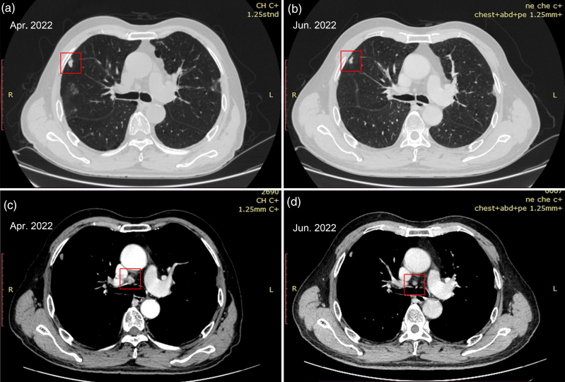 Pembrolizumab treatment in SMARCA4-deficient nonsmall cell lung cancer: high tumor mutational burden and programmed death-ligand 1(+) expression on circulating tumor cells for real-time monitoring: a case report.