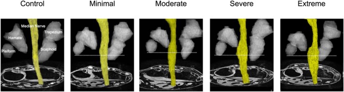 Three-Dimensional Magnetic Resonance Imaging of Median Nerve Volume for Assessing Carpal Tunnel Syndrome Severity.