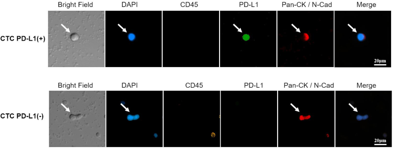 Pembrolizumab treatment in SMARCA4-deficient nonsmall cell lung cancer: high tumor mutational burden and programmed death-ligand 1(+) expression on circulating tumor cells for real-time monitoring: a case report.