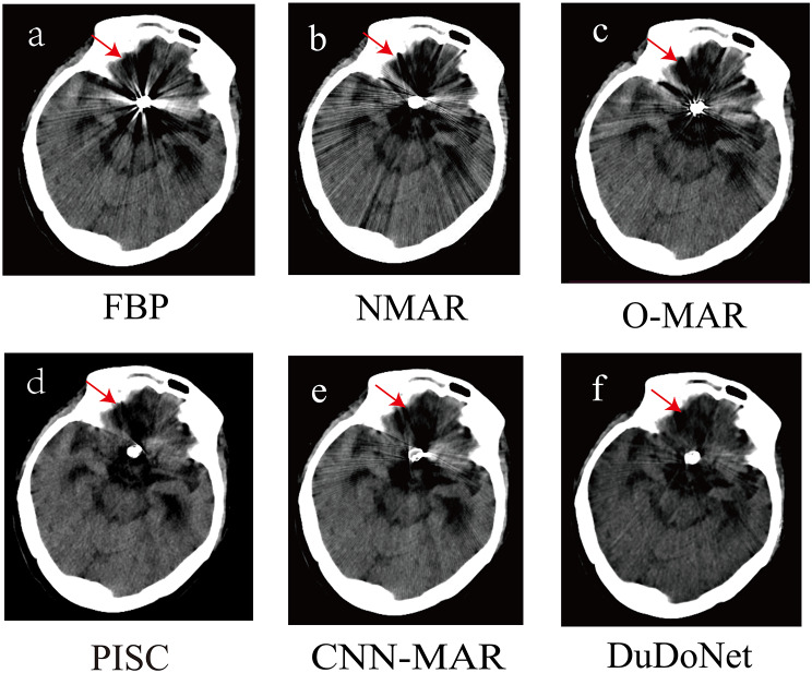 Physics-informed sinogram completion for metal artifact reduction in ...