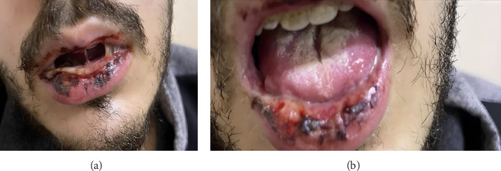 Levofloxacin-Induced Fuchs Syndrome: A Rare Atypical Stevens-Johnson Syndrome Variant With a Comprehensive Literature Review.