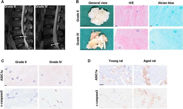ASIC1a Promotes nucleus pulposus derived stem cells apoptosis through modulation of SIRT3-dependent mitochondrial redox homeostasis in intervertebral disc degeneration.
