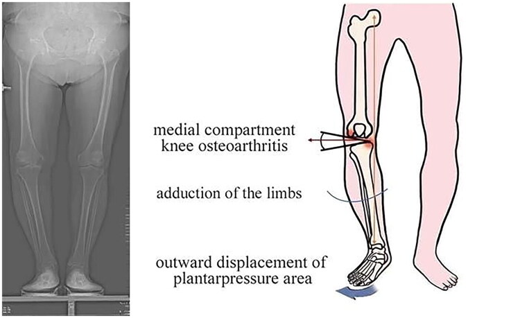 Association between knee osteoarthritis and foot deformities: epidemiological analysis of hallux valgus and flatfoot.