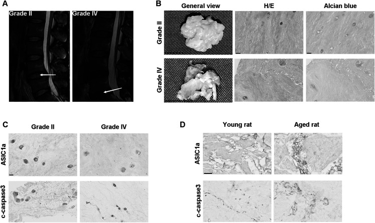 ASIC1a Promotes nucleus pulposus derived stem cells apoptosis through modulation of SIRT3-dependent mitochondrial redox homeostasis in intervertebral disc degeneration.