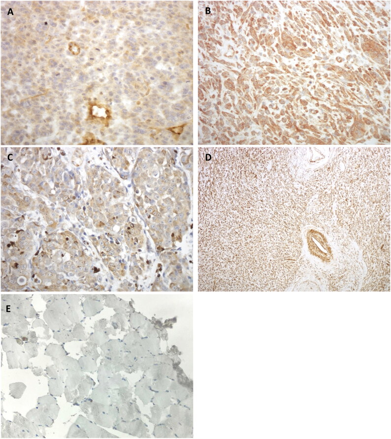 Clinical evaluation of HuDo-CSPG4 DNA electroporation as adjuvant treatment for canine oral malignant melanoma: comparison of two vaccination protocols.